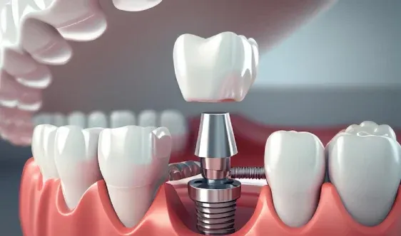 Dental Implants